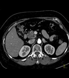 Intraductal Papillary Mucinous Neoplasm (IPMN) With Dysplastic Changes - CTisus CT Scan