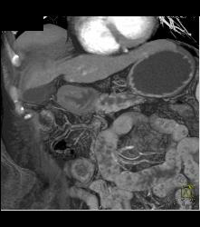 Intraductal Papillary Mucinous Neoplasm (IPMN) With Dysplastic Changes - CTisus CT Scan