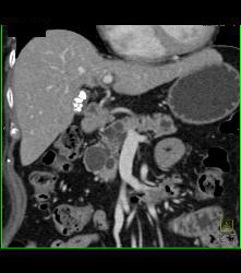 Intraductal Papillary Mucinous Neoplasm (IPMN) With Dysplastic Changes - CTisus CT Scan