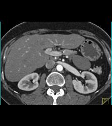 Lymphangioma - CTisus CT Scan