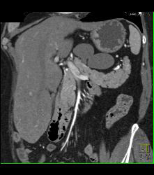 Lymphangioma - CTisus CT Scan