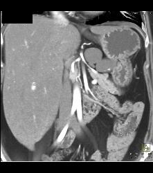 Lymphangioma - CTisus CT Scan