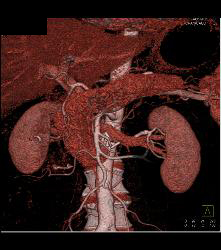 Normal Pancreas - CTisus CT Scan