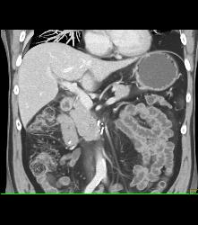 Head of Pancreas-lymphoma - CTisus CT Scan