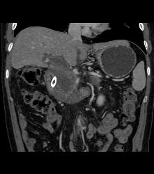 Lymphoma Involves Pancreas - CTisus CT Scan