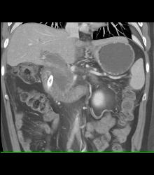 Lymphoma Involves Pancreas - CTisus CT Scan