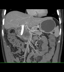 Lymphoma Involves Pancreas - CTisus CT Scan