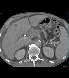 Adenocarcinoma of the Pancreas With Liver Metastases and Encased PV/SMV - CTisus CT Scan