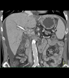 Adenocarcinoma of the Pancreas With Liver Metastases and Encased PV/SMV - CTisus CT Scan