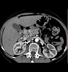 Gastrinoma - CTisus CT Scan