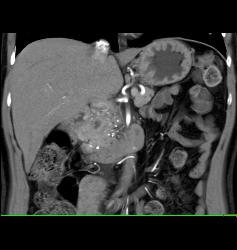 Gastrinoma - CTisus CT Scan