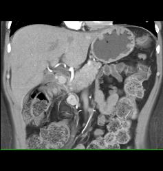 Gastrinoma - CTisus CT Scan