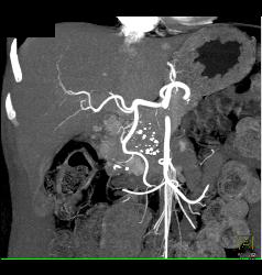 Gastrinoma - CTisus CT Scan