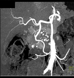 Gastrinoma - CTisus CT Scan