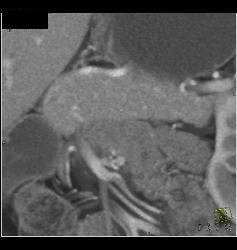 5mm Islet Cell Tumor - CTisus CT Scan