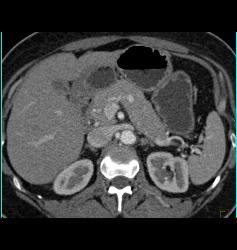 5mm Islet Cell Tumor - CTisus CT Scan