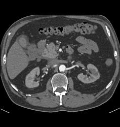 Duodenal Cancer With Nodes Simulates A Pancreatic Mass - CTisus CT Scan