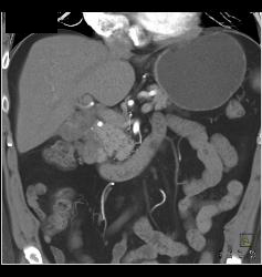 Duodenal Cancer With Nodes Simulates A Pancreatic Mass - CTisus CT Scan