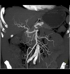 Duodenal Cancer With Nodes Simulates A Pancreatic Mass - CTisus CT Scan