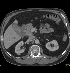 Duodenal Cancer With Nodes Simulates A Pancreatic Mass - CTisus CT Scan