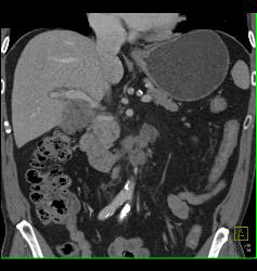 Duodenal Cancer With Nodes Simulates A Pancreatic Mass - CTisus CT Scan