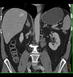 Duodenal Cancer With Nodes Simulates A Pancreatic Mass - CTisus CT Scan