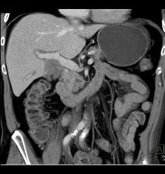 Duodenal Cancer With Nodes Simulates A Pancreatic Mass - CTisus CT Scan