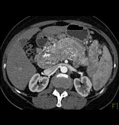 Islet Cell Tumor Invades the Portal Vein With Huge Varices - CTisus CT Scan