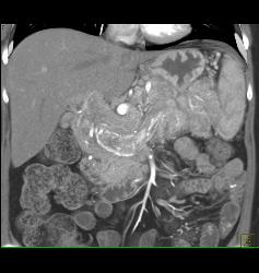 Islet Cell Tumor Invades the Portal Vein With Huge Varices - CTisus CT Scan