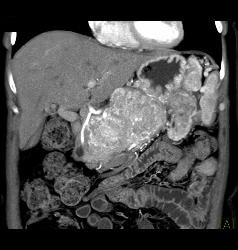 Islet Cell Tumor Invades the Portal Vein With Huge Varices - CTisus CT Scan