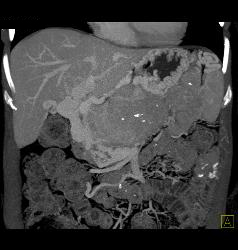 Islet Cell Tumor Invades the Portal Vein With Huge Varices - CTisus CT Scan