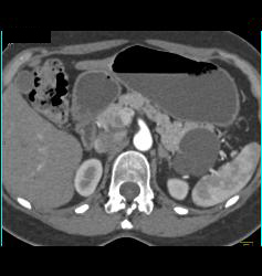 Serous Cystadenoma - CTisus CT Scan