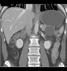 Serous Cystadenoma - CTisus CT Scan