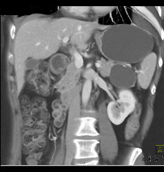 Serous Cystadenoma - CTisus CT Scan