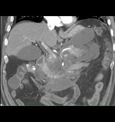 Acute Pancreatitis With Pseudocysts - CTisus CT Scan