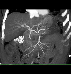 Acute Pancreatitis With Pseudocysts - CTisus CT Scan