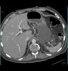 Acute Pancreatitis With Pseudocysts - CTisus CT Scan