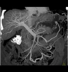 Acute Pancreatitis With Pseudocysts - CTisus CT Scan