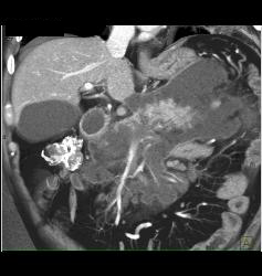 Acute Pancreatitis With Pseudocysts - CTisus CT Scan