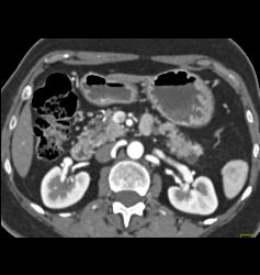 Multiple Intraductal Papillary Mucinous Neoplasms (IPMNs) - CTisus CT Scan