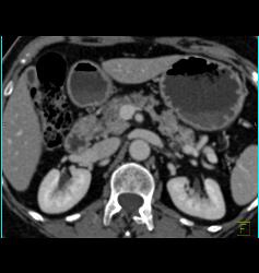 Multiple Intraductal Papillary Mucinous Neoplasms (IPMNs) - CTisus CT Scan