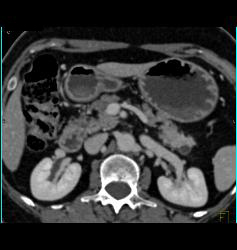 Multiple Intraductal Papillary Mucinous Neoplasms (IPMNs) - CTisus CT Scan