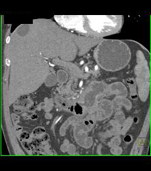 Intraductal Papillary Mucinous Neoplasm (IPMN) and Duodenitis - CTisus CT Scan