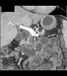 Intraductal Papillary Mucinous Neoplasm (IPMN) and Duodenitis - CTisus CT Scan