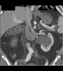 Superior Mesenteric Artery (SMA) Dissection - CTisus CT Scan