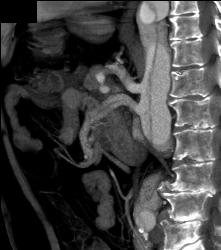 Superior Mesenteric Artery (SMA) Dissection - CTisus CT Scan