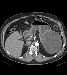 Hemorrhagic Pseudocyst Due to Pancreatitis - CTisus CT Scan