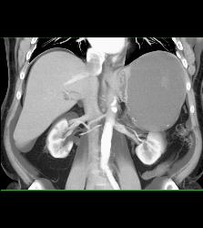 Hemorrhagic Pseudocyst Due to Pancreatitis - CTisus CT Scan