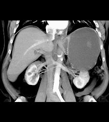 Hemorrhagic Pseudocyst Due to Pancreatitis - CTisus CT Scan