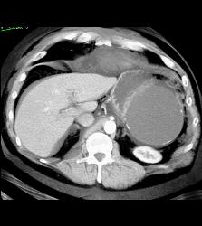 Hemorrhagic Pseudocyst Due to Pancreatitis - CTisus CT Scan